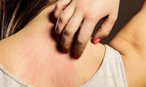 رفع خارش پوست