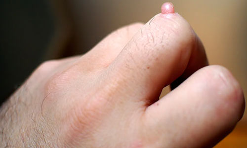 درمان زگیل از فواید سرکه سیب