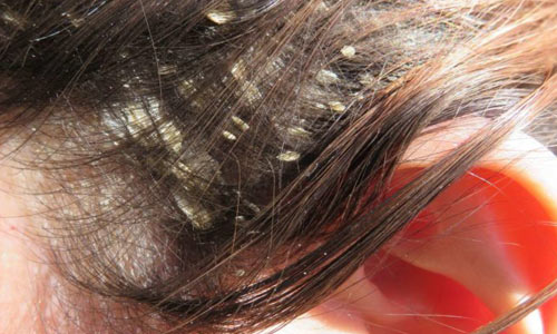 رفع شوره سر