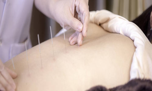 طب سوزنی برای درمان درد قاعدگی